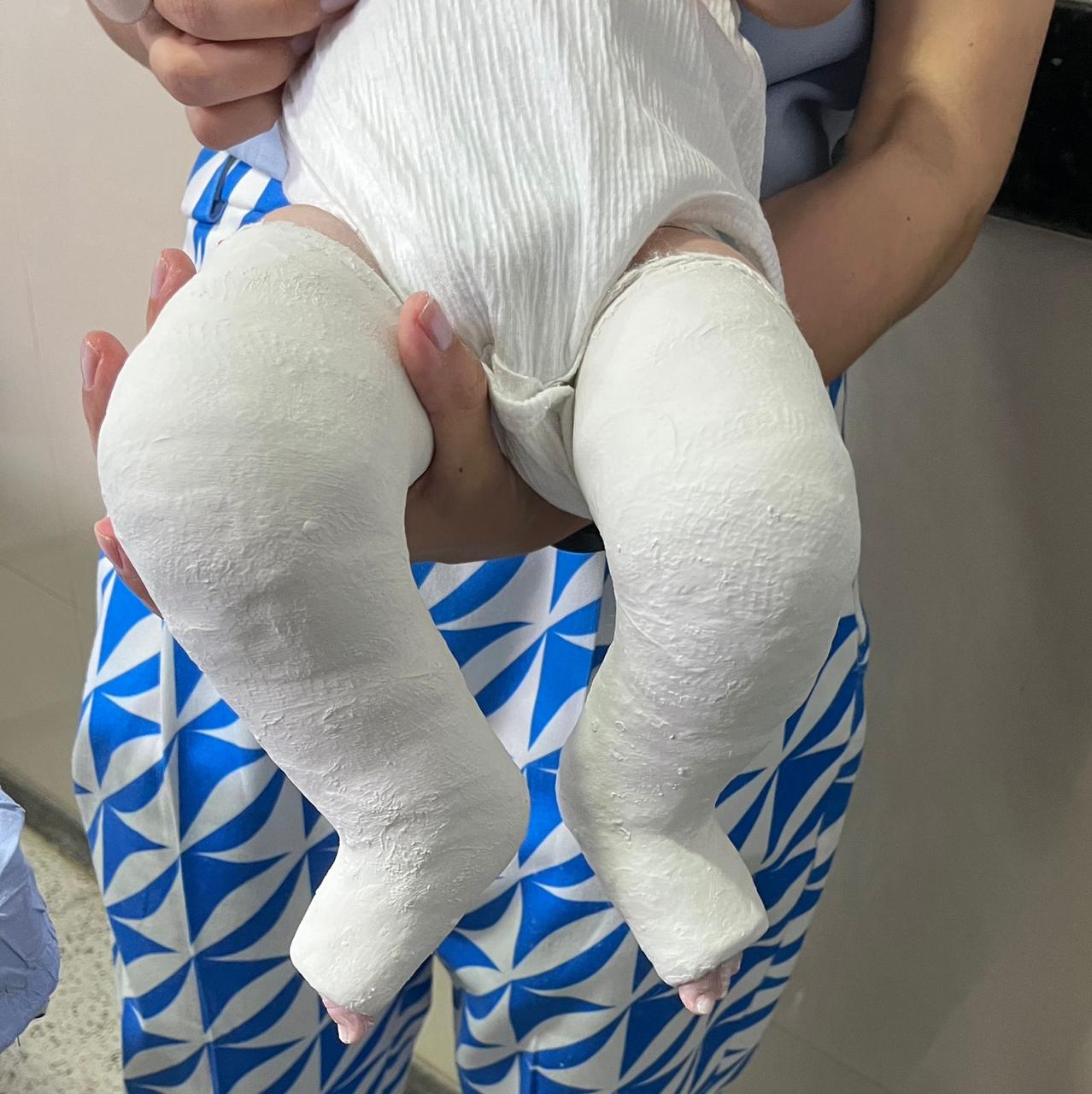 Imagem destacada do post: HMAP realiza cirurgias para tratar “pé torto”